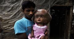Baby Roona Begum undergoes surgery for hydrocephalus – will she able to lead a normal life?